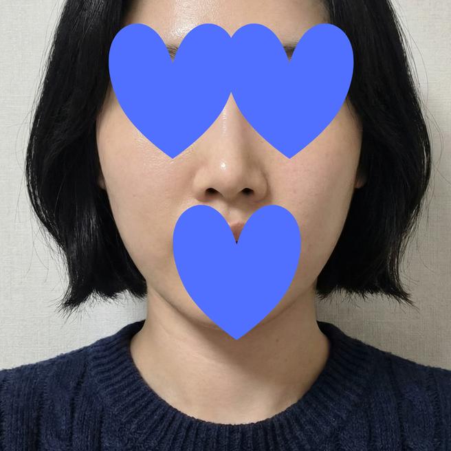쥬베룩 1주차 솔직후기 – 붓기 빠지니까 광채가 미쳤어요