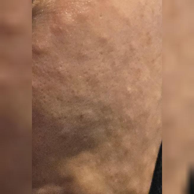 상담부터 시술까지 너무 만족, 리즈네 강추예요ㅎㅎ
