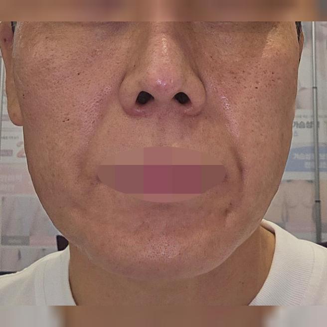 거친 피부이랑 모공 고민으로 쥬베룩 받아봤습니다.