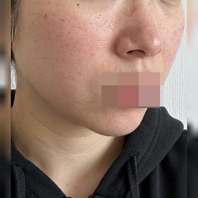 수면으로 아픔 없이! 한 번에 관리 가능한 리쥬쎄라 강추예요