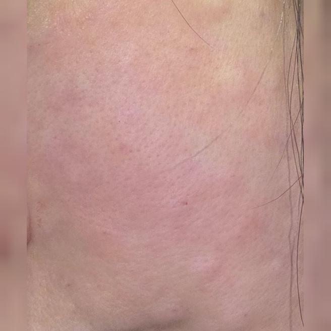 엠보 볼록하게 잘 올라와서 다음 시술까지 계획 중이에요ㅎㅎ