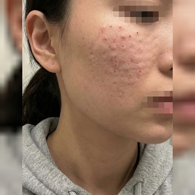 눈가 잔주름 때문에 받았는데 꼼꼼하고 신속해서 계속 다니는 것 같아요!