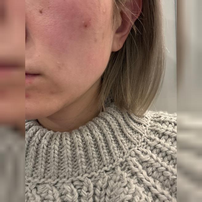 일본어 상담 되는 곳에서 리쥬란 시술 받았어요~