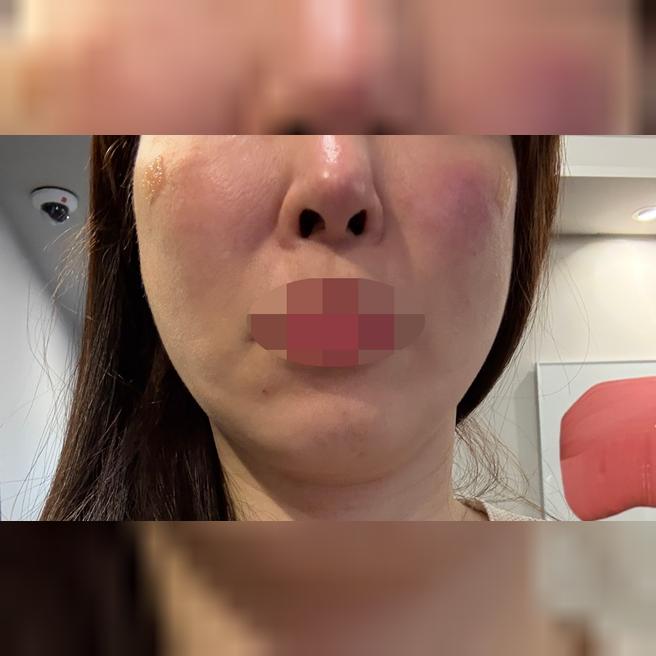 빠른 응대와 친절한 상담으로 기분 좋게 리쥬란 받았어요ㅎㅎ~