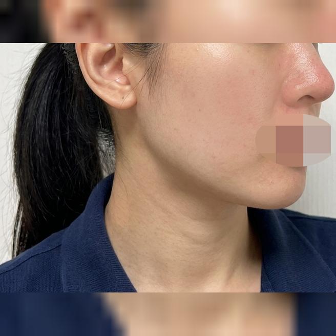 스킨보톡스 덕분에 피부가 매끈해지고 대만족 입니다~!