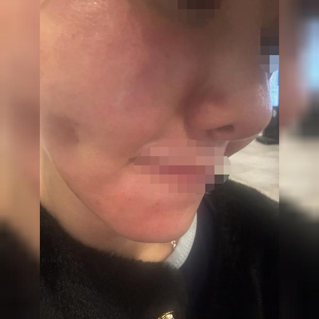 갑자기 생긴 여드름 자국, 엑소좀으로 관리하니 확연히 달라졌어요~