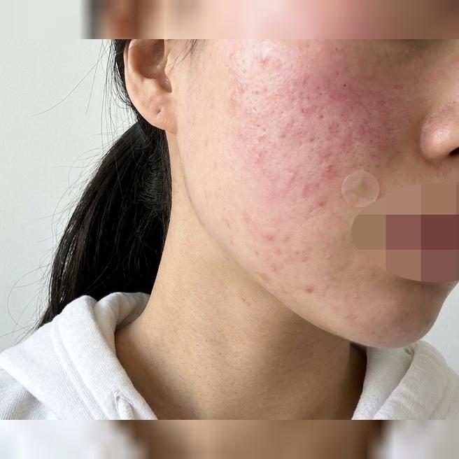수면으로 안 아프게 받고 하루 만에 결 개선까지 느꼈어요~ㅎㅎ