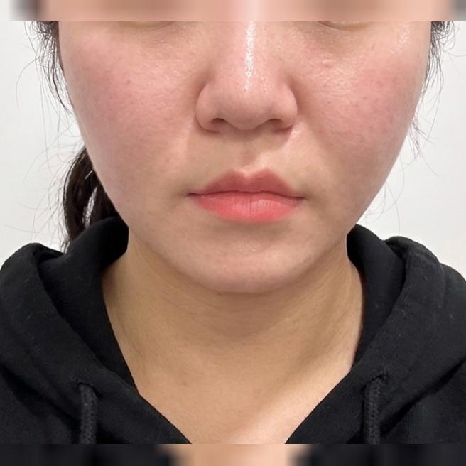 턱살이랑 리프팅 시기에 맞춰 온다 + 티타늄 같이 받았어요ㅎㅎ