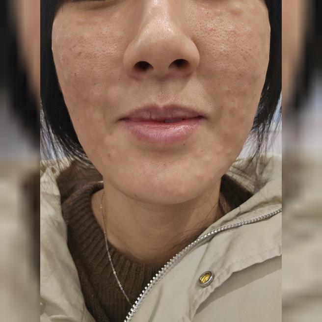 리쥬란 2주차 후기! 친절하고 안 아팠어요