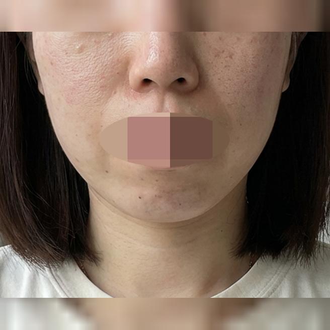 여름에도 속건조는 여전해서 리쥬란 받으러 방문했어요~