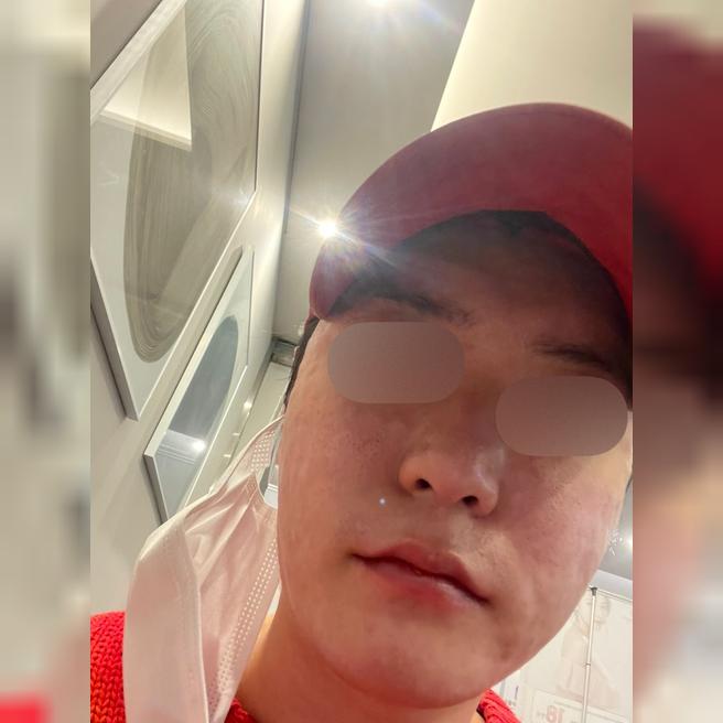 리쥬란 3일차, 겨울 푸석피부가 촉촉해졌어요