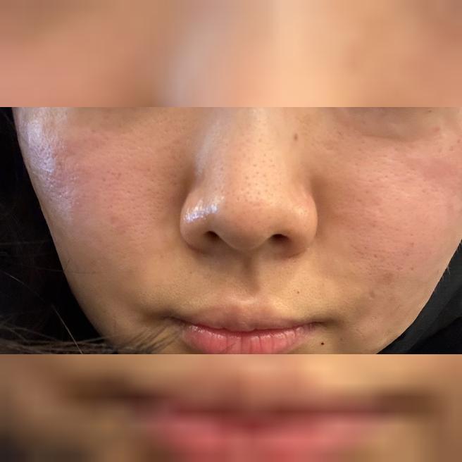 리쥬란 5일차 솔직후기, 모공 속 윤기가 차오르는 느낌"