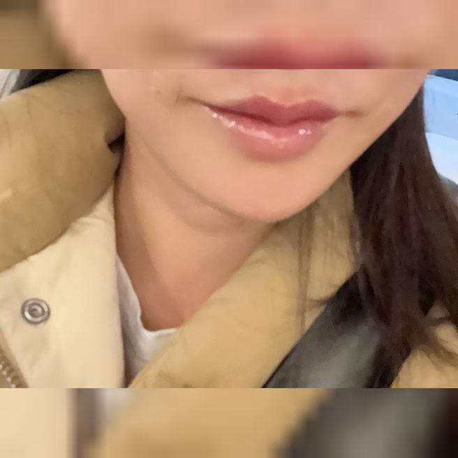 빠른 진행에 꼼꼼한 입술 필러, 다음에도 또 올 것 같아요~