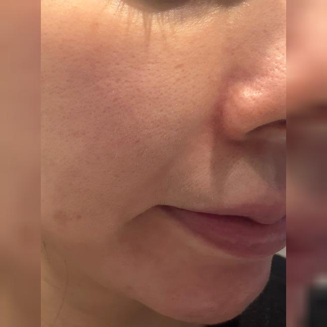 리쥬베룩 맞고 3일째입니다!! 붉은 기 있는데 피부 속은 촉촉한 느낌?
