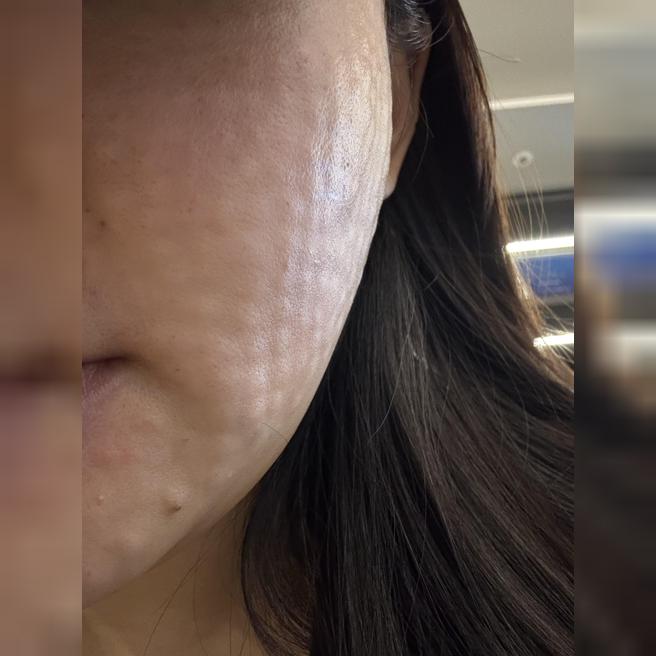 속건조 고민으로 리쥬란힐러 받았는데 꼼꼼해서 좋은 것 같아요 ㅎㅎ
