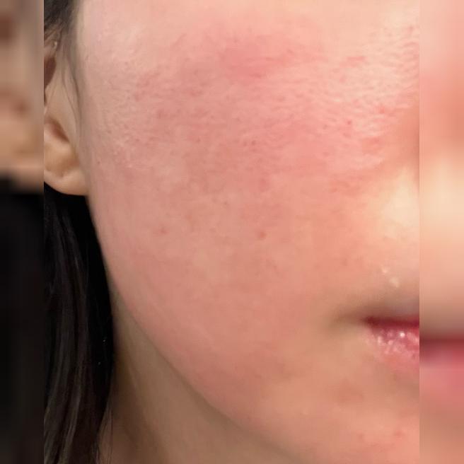 시술 시간 짧은데 디테일까지 살아있어서 기분 좋게 다녀왔어요!