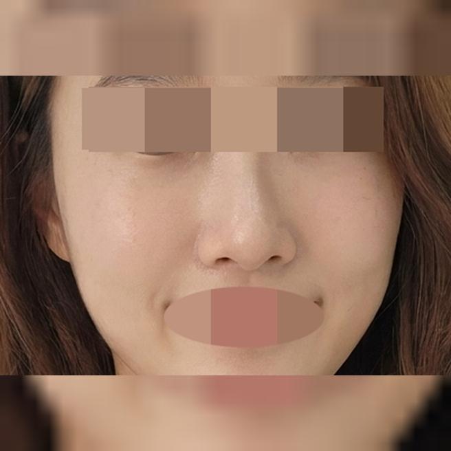 또렷한 인상 되찾으려고 아이써마 수면으로 받아봤어요!
