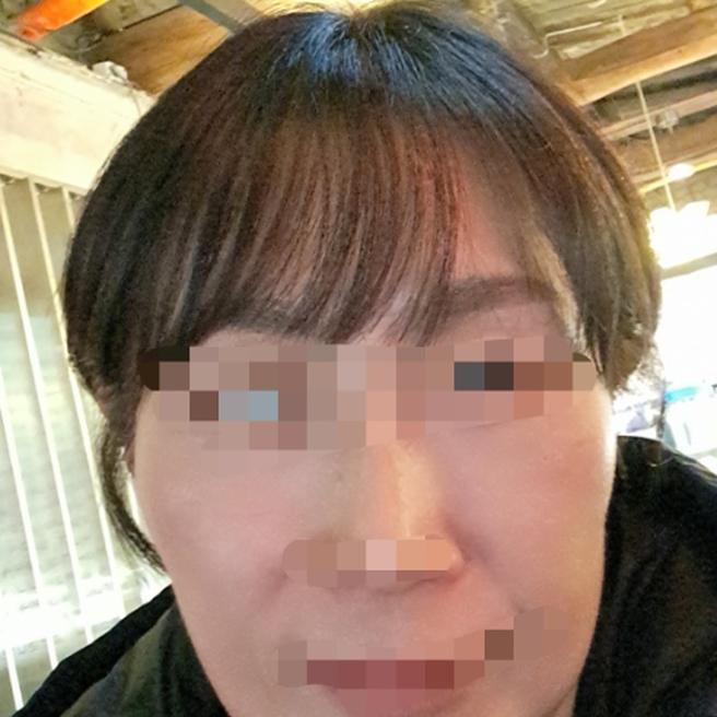 리쥬란 3일됐어요 피부 컨디션 회복 중