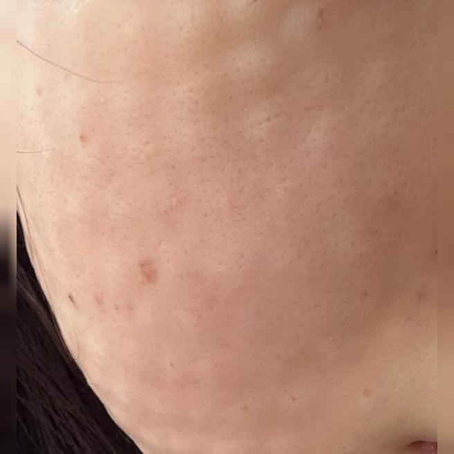 일본에서 방문했는데 통증 없이 엠보까지 예쁘게 잘 나와서 만족이에요!