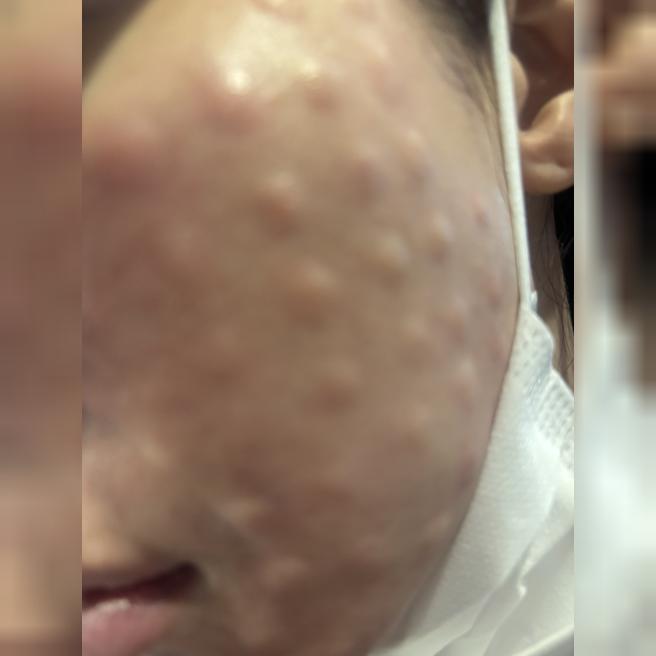 속건조 고민으로 시작한 리쥬란, 꾸준히 받기로 결심했어요!