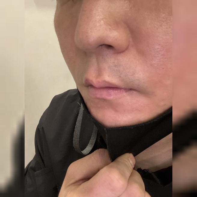칙칙한 피부 고민으로 리쥬란 수면으로 또 받아봤어요.