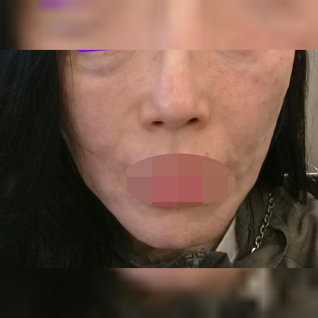 지인 소개로 방문한 곳, 부담 없이 받기 좋은 리쥬란 후기예요ㅎㅎ