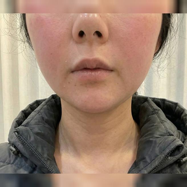 친구 소개로 목주름 시술 받았는데 만족이에요