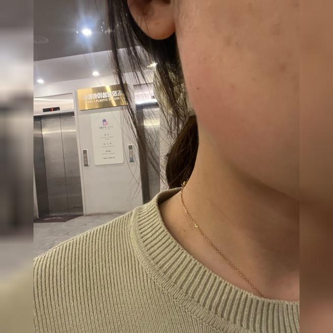 사각턱 보톡스 후기, 대기 없고 상담 친절해요