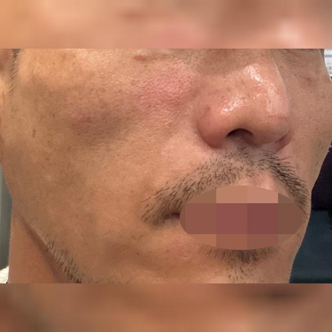 수면 리쥬란, 엠보도 확실하고 다른 병원들보다 만족도가 높습니다.