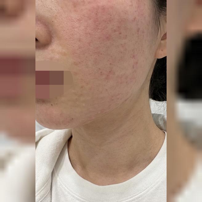계절 상관없이 속건조 심해서 리쥬란과 스킨보톡스 같이 받아봤어요