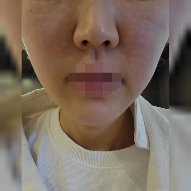 수면으로 통증 없이 리쥬란, 작년부터 꾸준히 이용하고 있어요