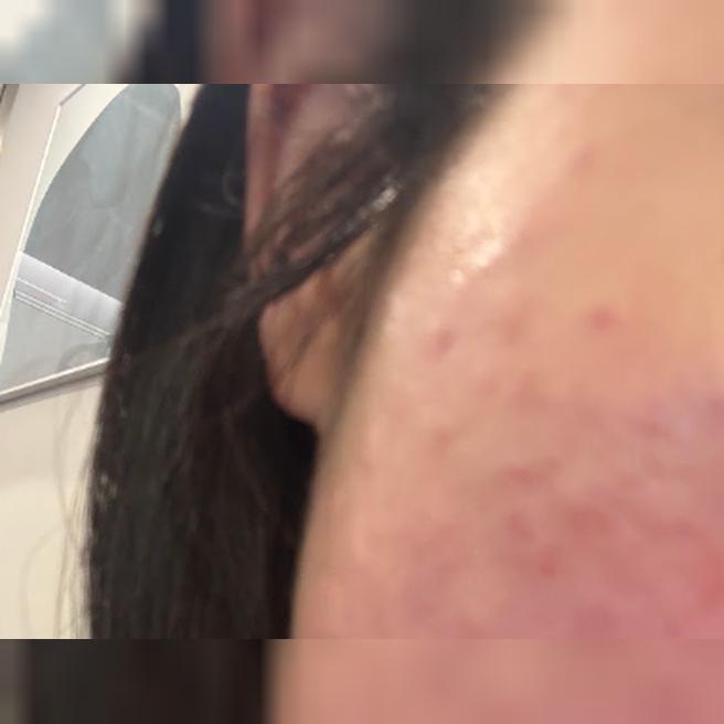 맞고 하루 됐어요! 리쥬베룩 1일차 후기!