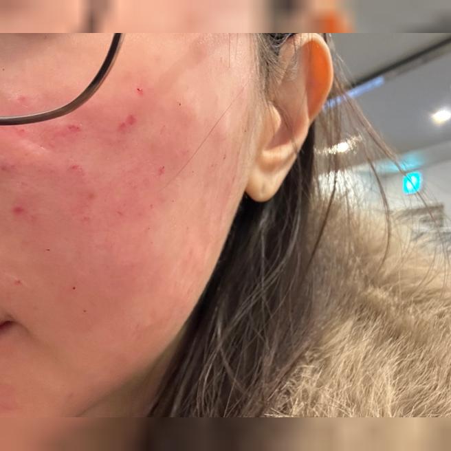 턱이랑 볼 건조해서 받았는데 요청대로 잘 해주신 것 같아요 ㅎㅎ