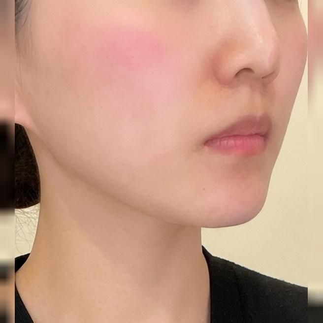 마이크로파로 진피층 자극, 얼굴 라인 정리에 딱 좋은 온다리프팅이에요