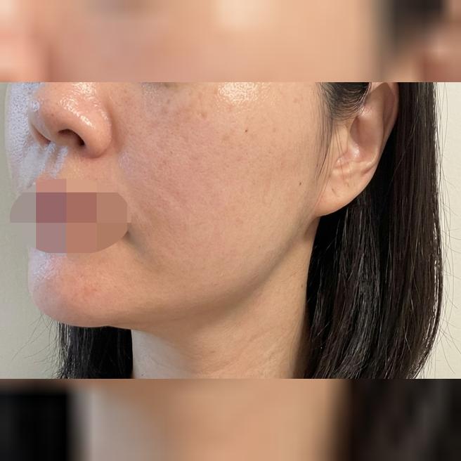 거칠해지고 모공 늘어진 피부 고민, 쥬베룩으로 잡으러 다녀왔어요!