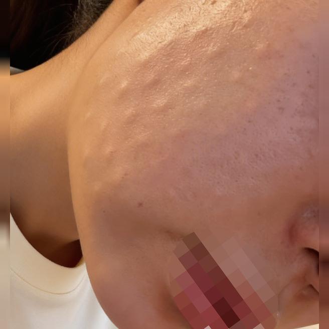피부결 고민으로 리쥬란힐러 수면으로 편하게 받아봤어요!