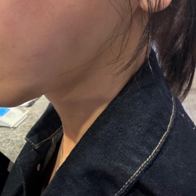 리쥬란 시술 후 며칠째! 촉촉함 실화인 거 맞죠?