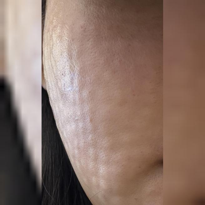 보이는 그대로 꼼꼼한 시술! 리쥬란 받길 잘했어요ㅎㅎ