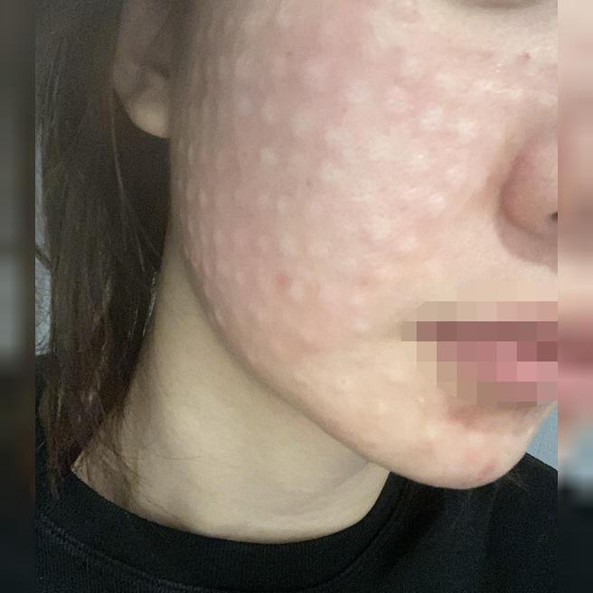엠보 꼼꼼하게 올라와서 첫 리쥬란 결과가 너무 기대돼요~ㅎㅎ