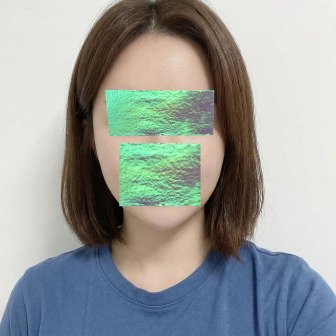 리쥬란 4주 지나고 느낀 점, 이건 진짜 갓술