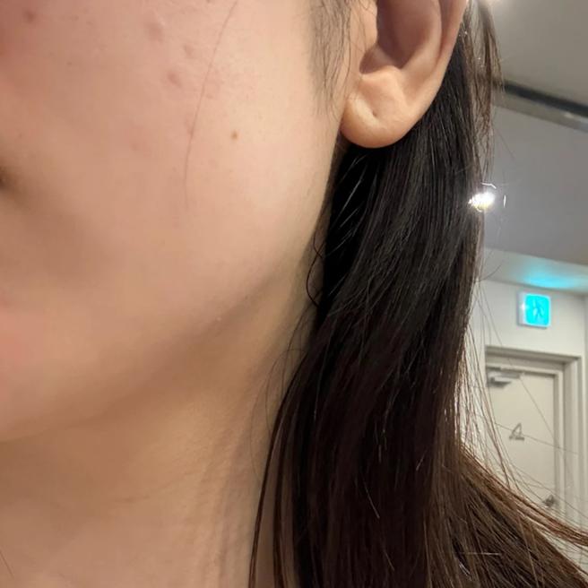 온다리프팅과 라리리쥬 받았는데 일본어 통역 있어서 최고예요 ㅎㅎ