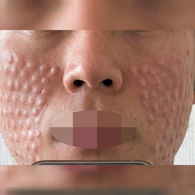 속당김이 가뭄처럼 심했는데 시술로 해결 된 것 같아요.