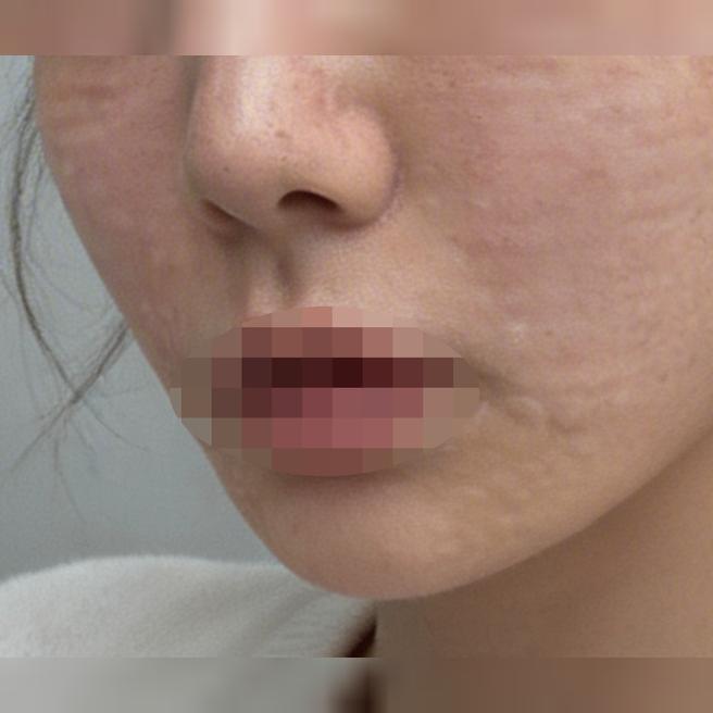 신부 관리로 피부 생기 채우려고 리쥬란 받아봤어요~!