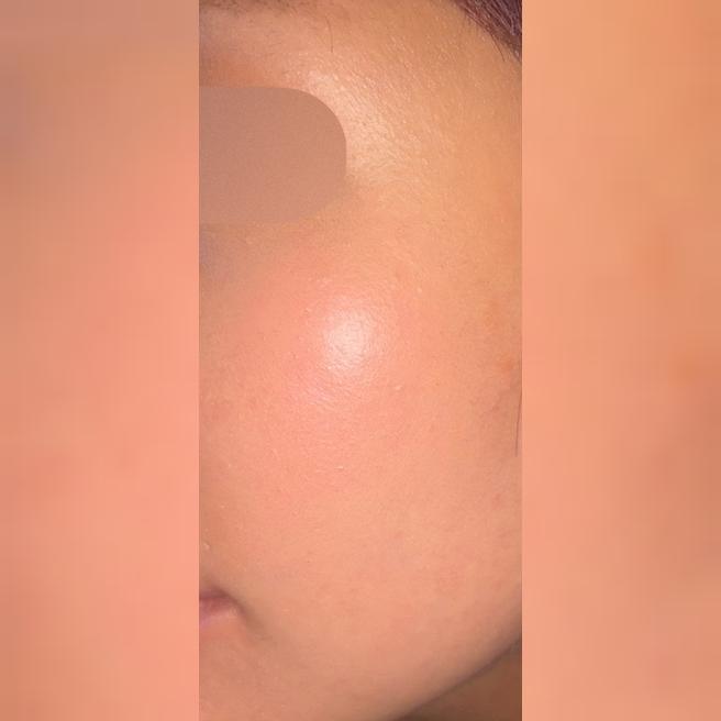 대기시간 없이 친절한 응대 덕분에 편하게 시술 받고 왔어요ㅎㅎ