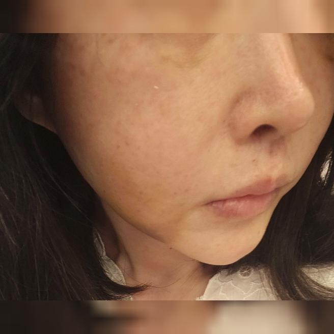 다른 곳에서 멍 심하게 들었던 기억에 걱정했는데 멍 없이 포텐자 받았어요!