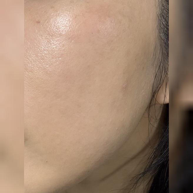 속건조랑 피부 개선 위해 재방문, 만족스럽게 받고 왔어요><