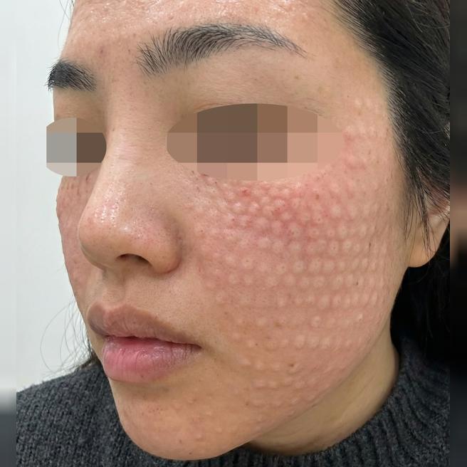 여기저기 맞아봤지만 리쥬란은 여기가 제일이에요~!