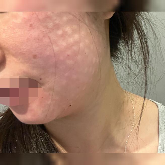 원장님 꼼꼼하고 상담 실장님도 친절한 리쥬란 받아봤어요