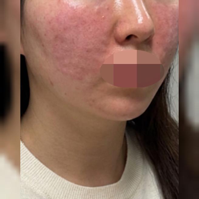 건성 피부와 잔주름까지 신경쓰여서 리쥬란 받았어요!