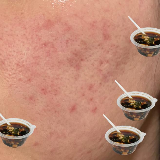 리쥬란 3일차 솔직 후기, 아직은 붉은 기가 조금 있어요